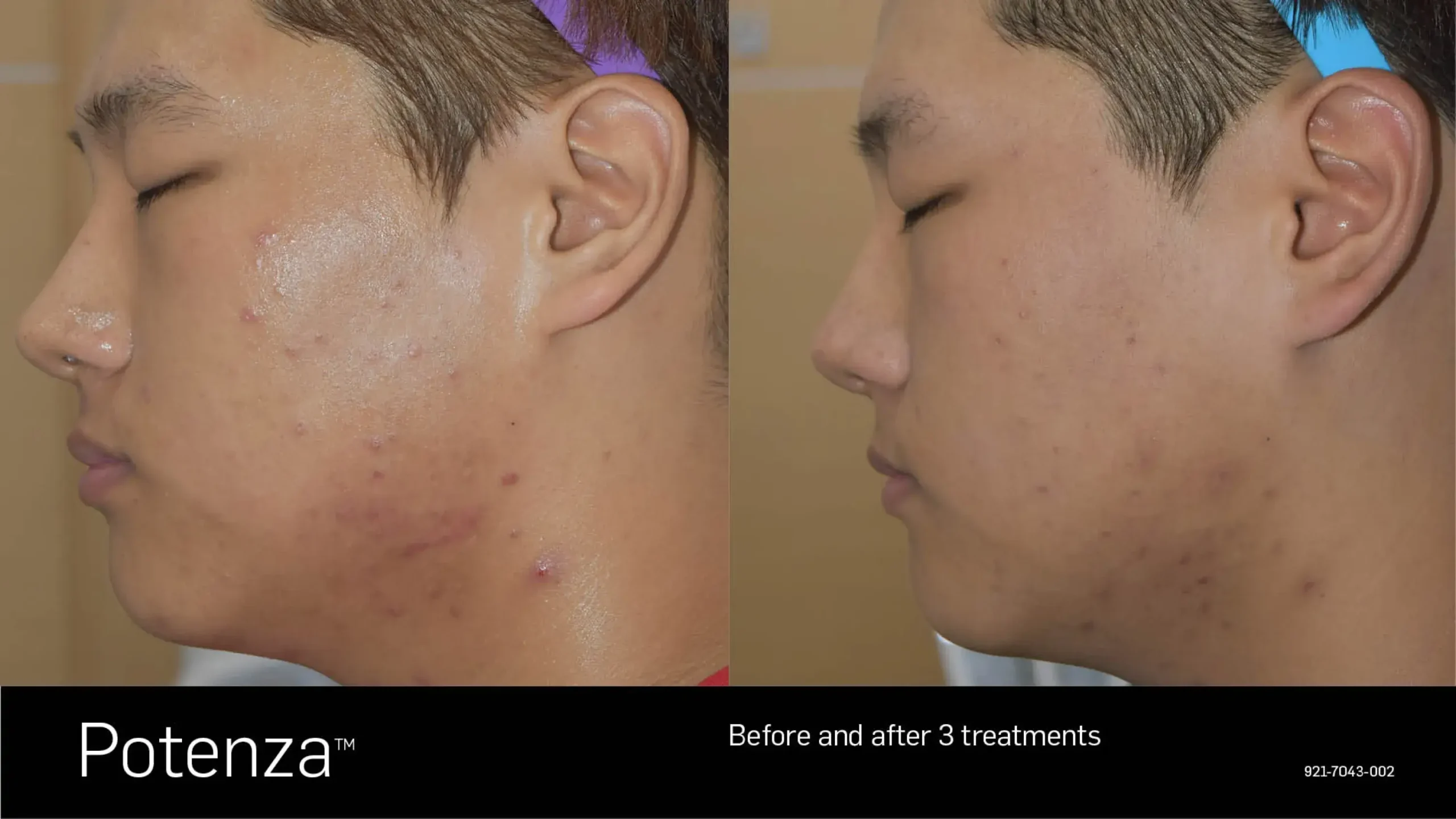 66cceba0029cc12464e34c18_potenza-before-after-15