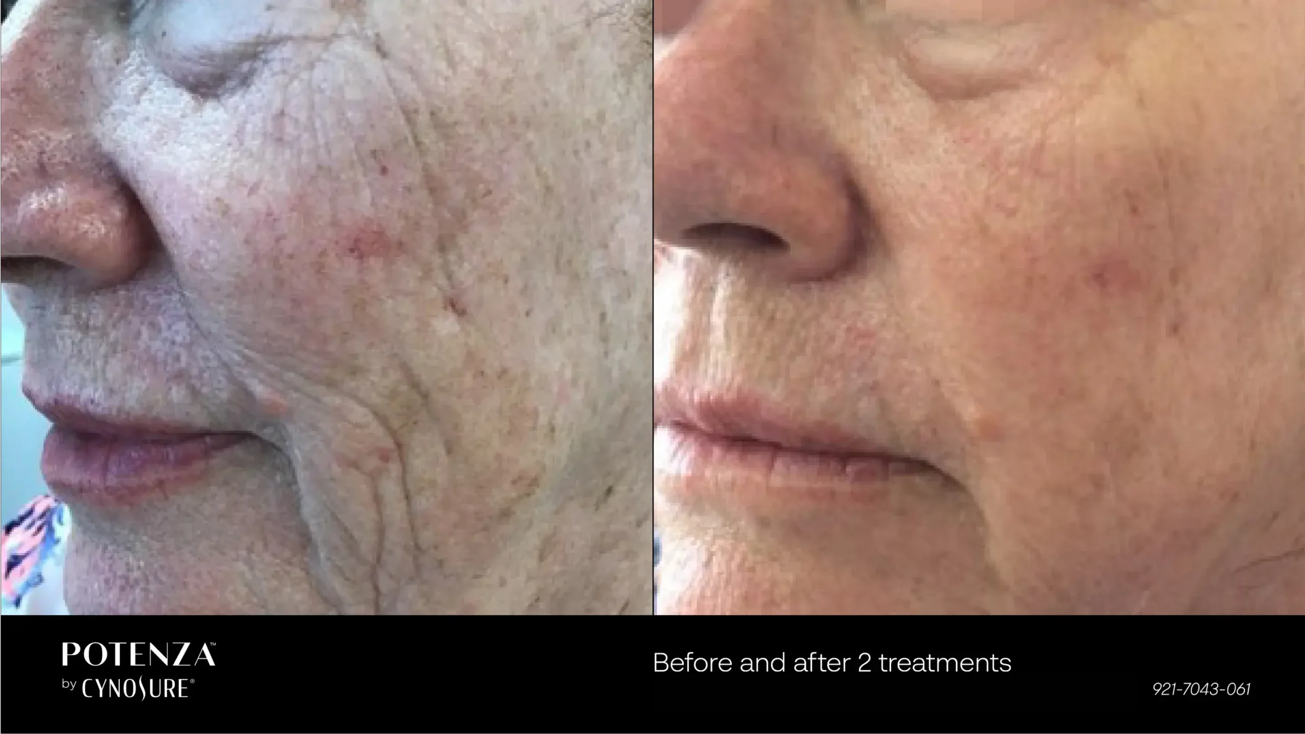 66cceba031e8f77c5db2e62a_potenza-before-after-10
