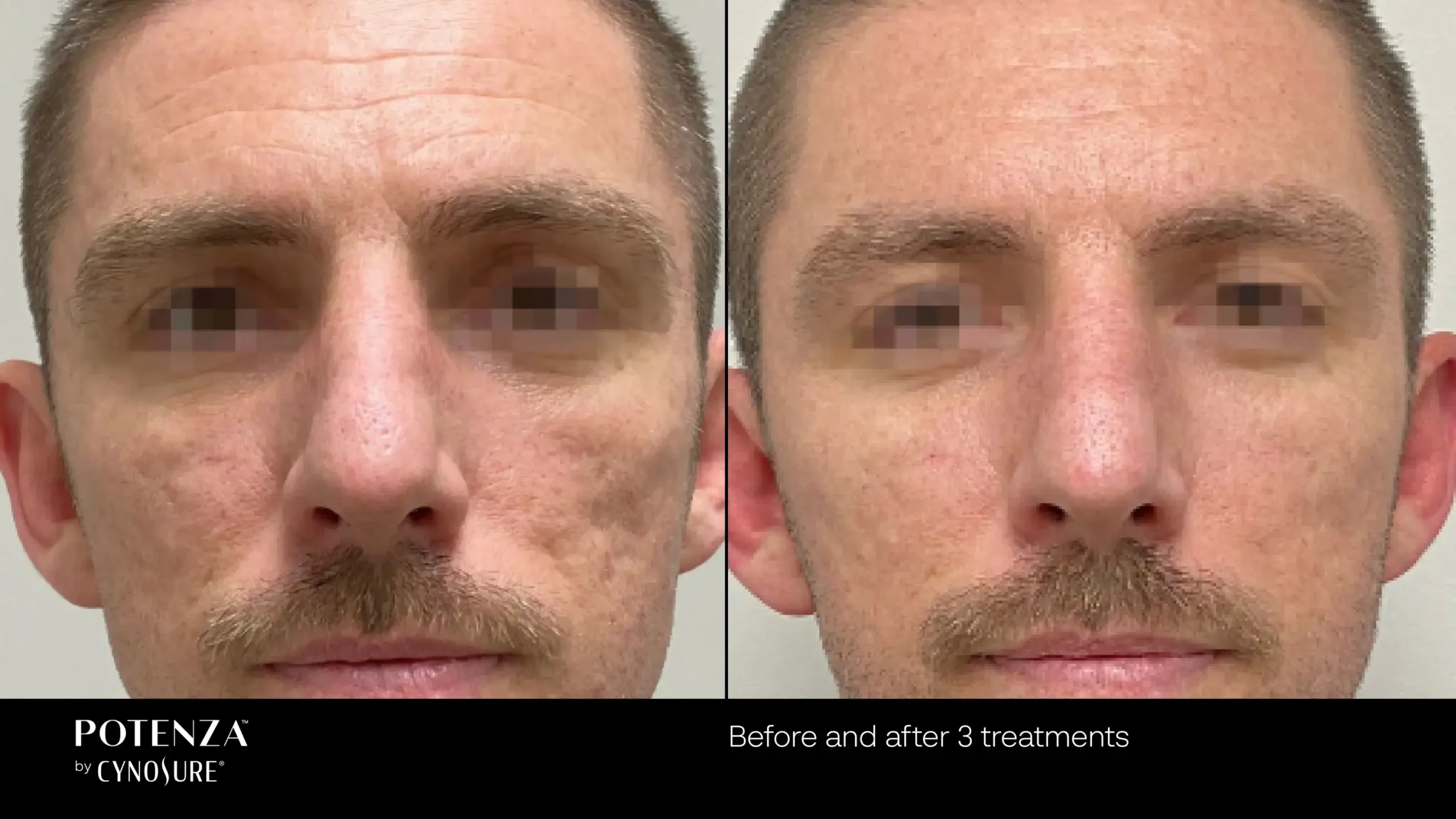66cceba057647df833eb2634_potenza-before-after-12