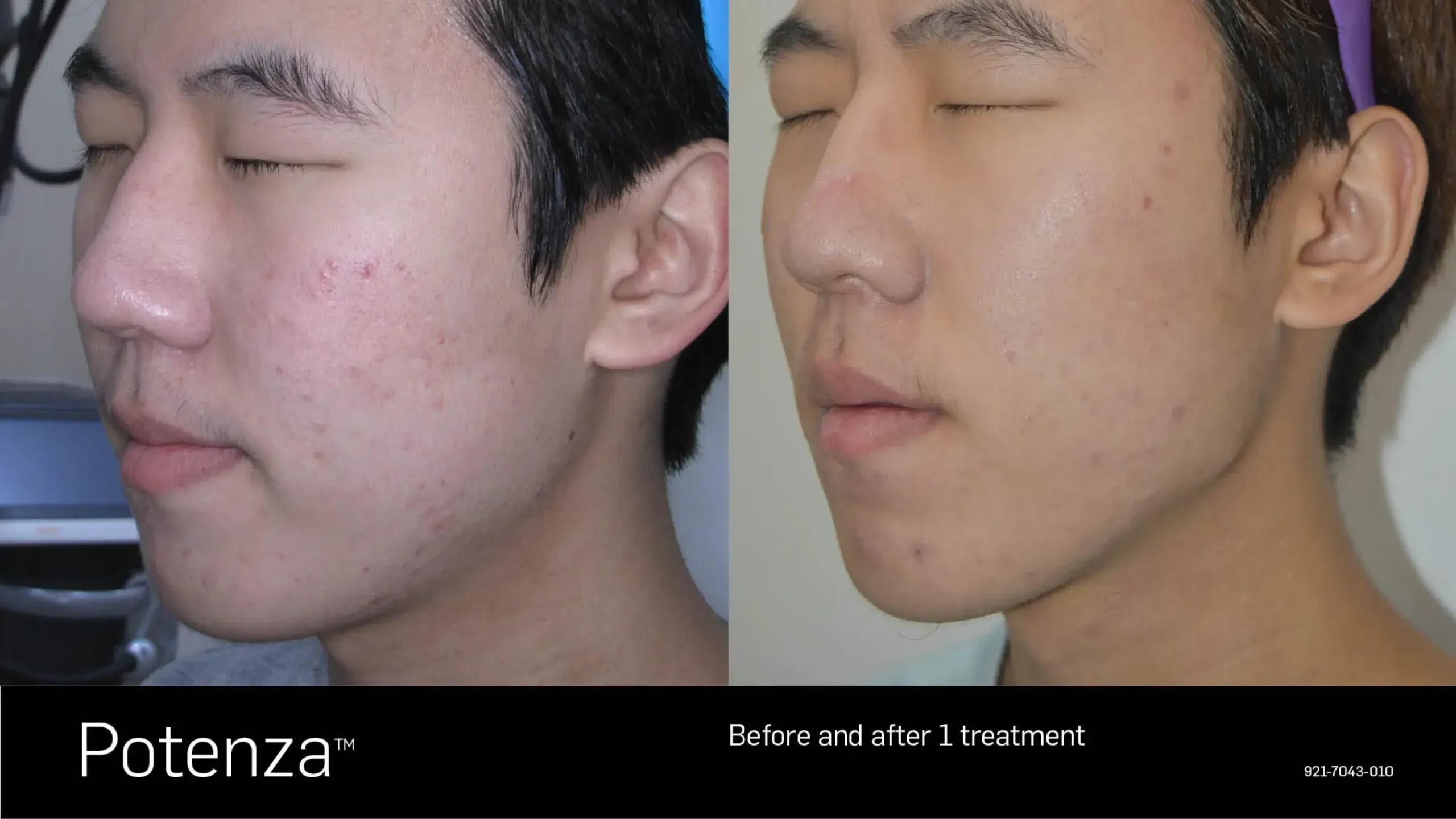 66cceba090134e71b7b071c0_potenza-before-after-03