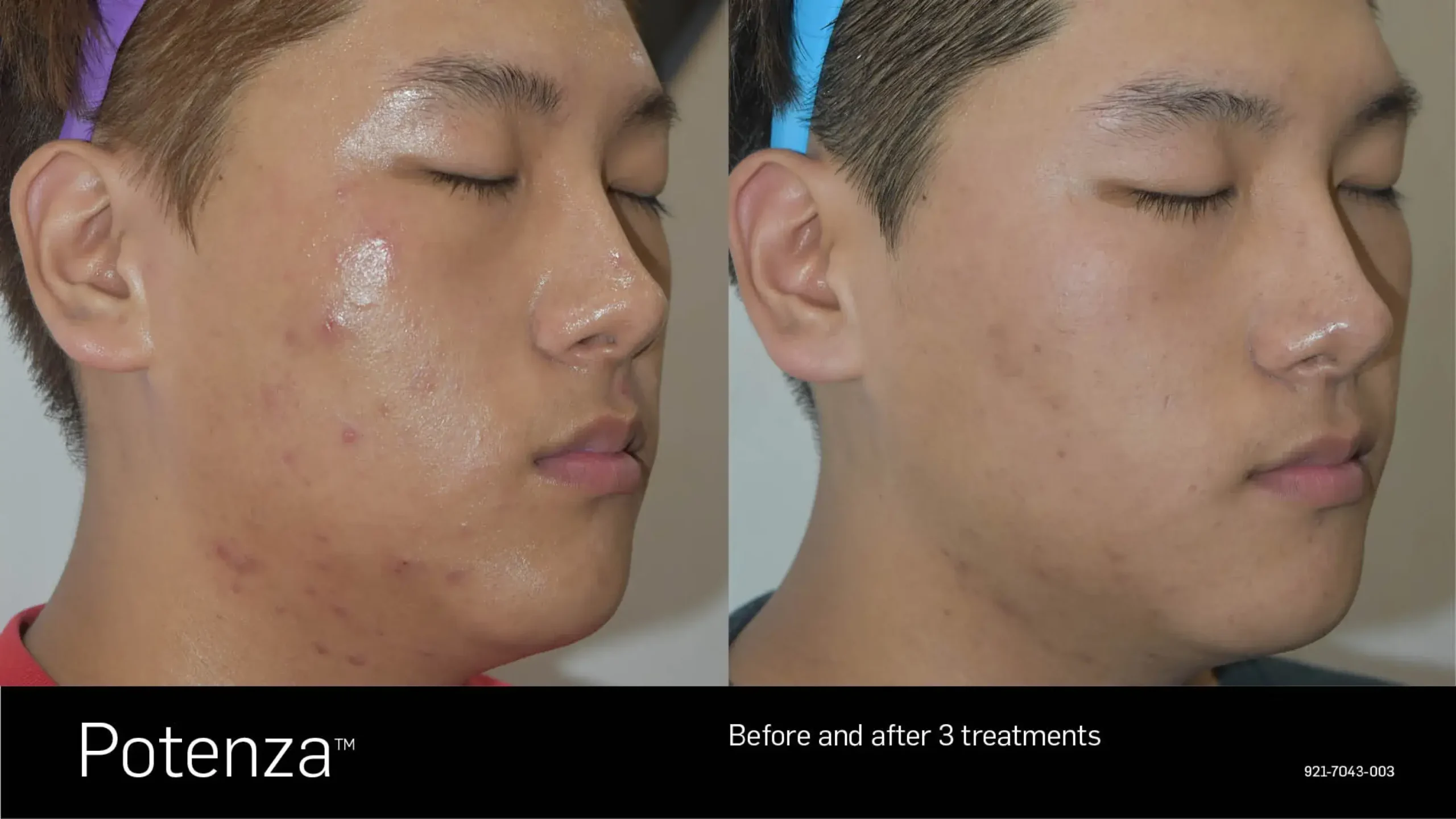 66cceba0b1a90062df488f30_potenza-before-after-16