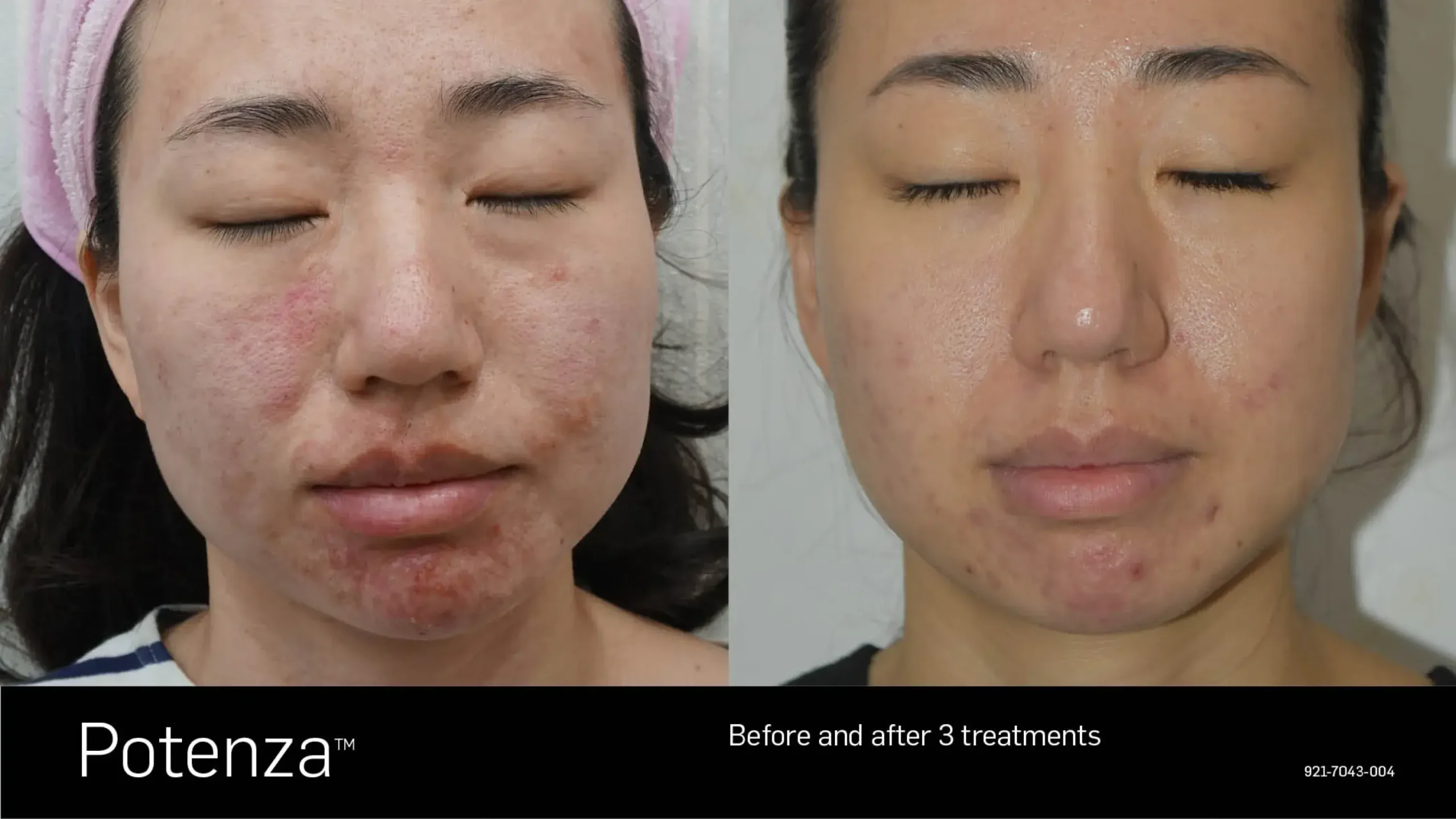 66cceba0c8e9136e8214250f_potenza-before-after-01