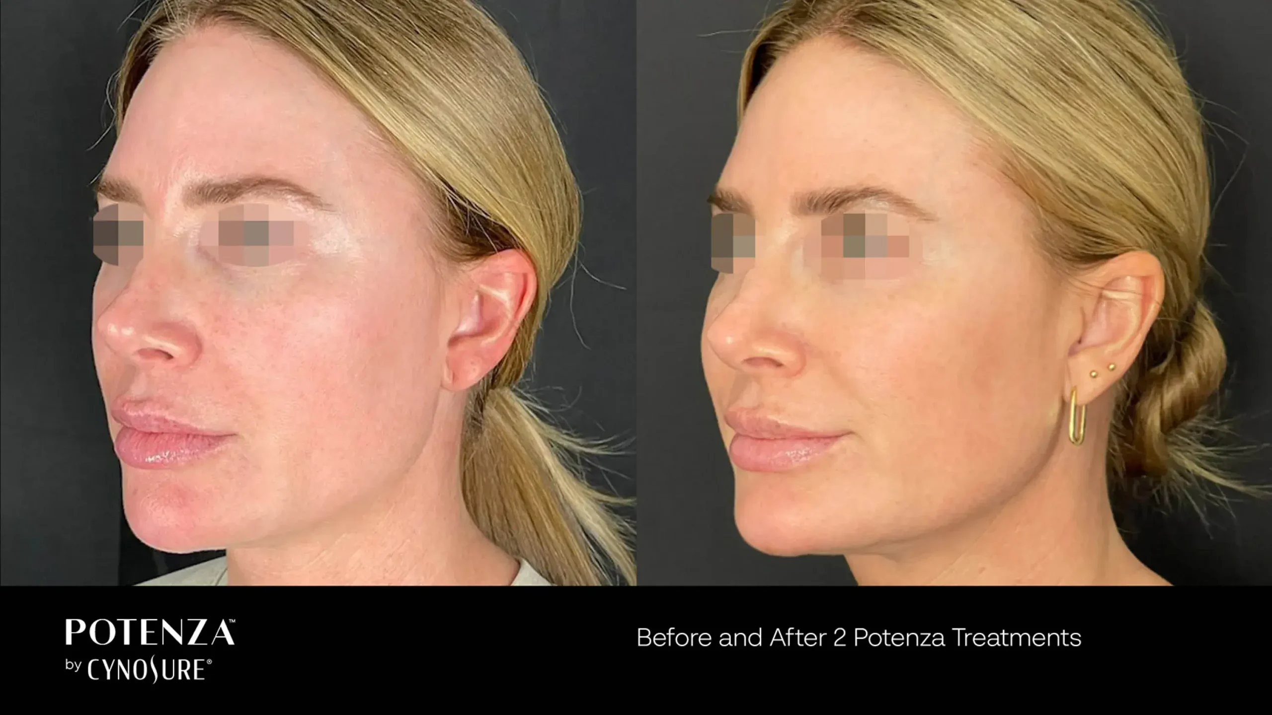 66cceba10f7ad7e536d3c1e9_potenza-before-after-13