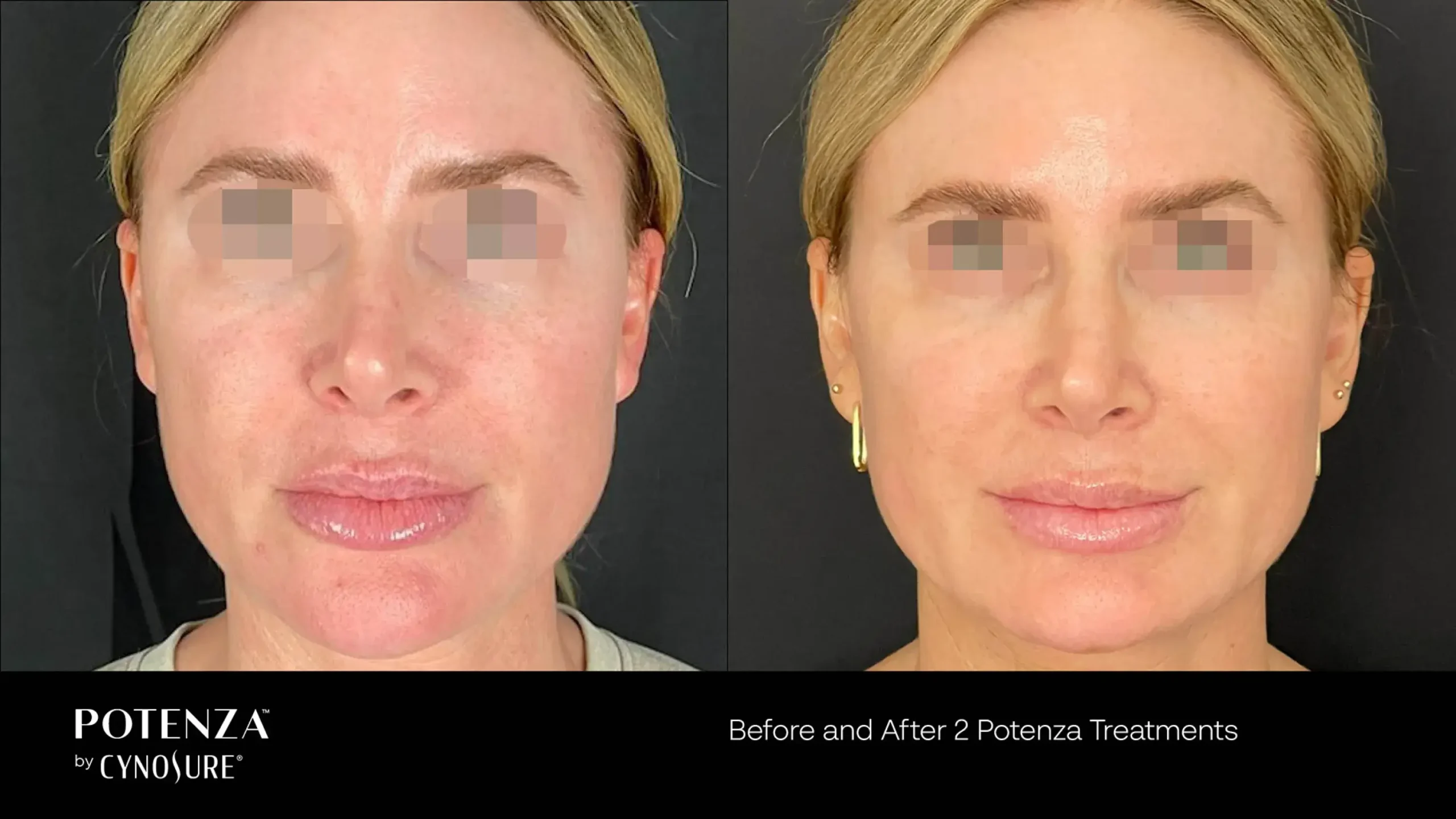 66cceba1b1f7940f499c8e46_potenza-before-after-14