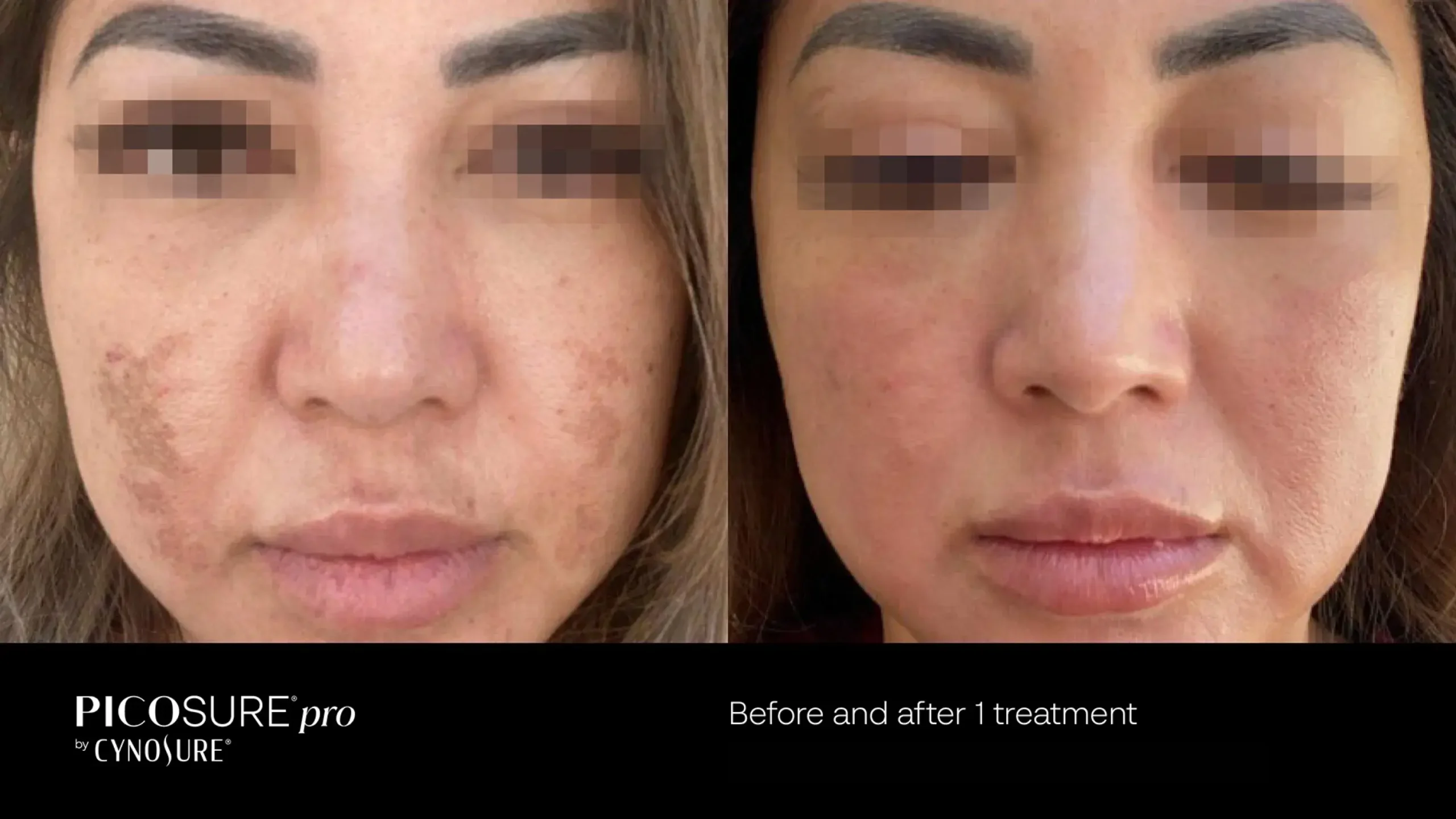 66ccf7d6e99d9f56e3f54c00_melasma-before-after-06 (1)
