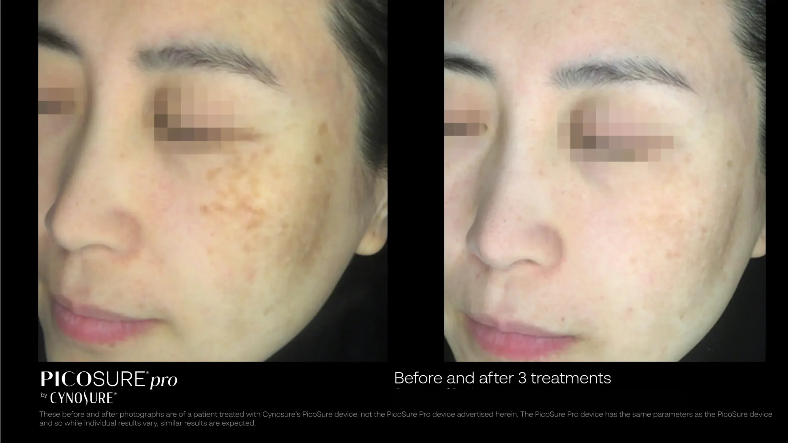 66ccf7d7029cc12464ee425d_melasma-before-after-04 (1)