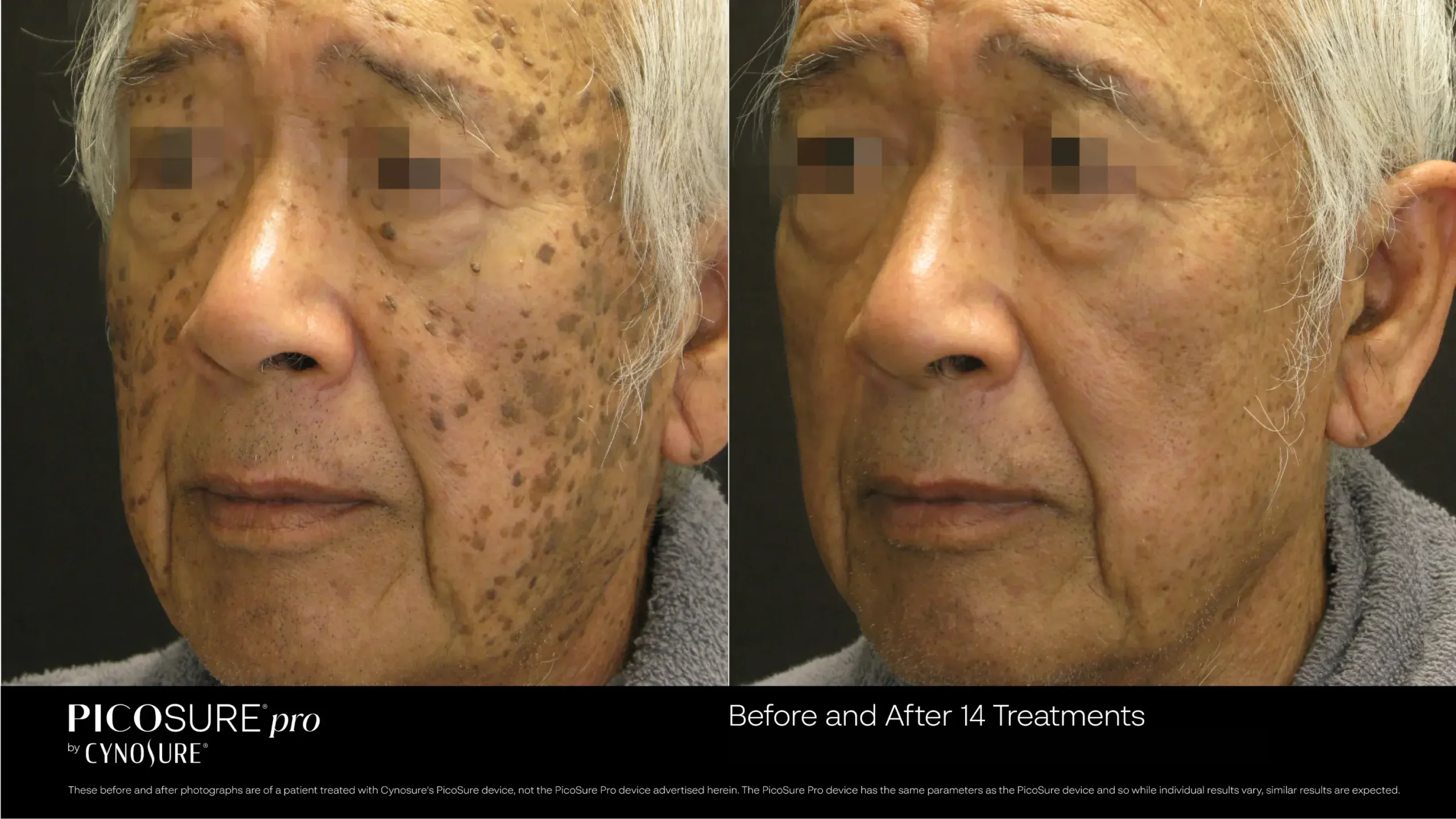 66ccf7d70b54bb42b8f00049_melasma-before-after-15 (1)
