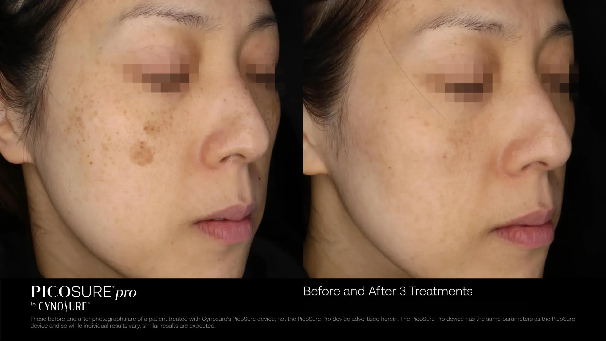 66ccf7d70e234a864d2bc738_melasma-before-after-14 (1)
