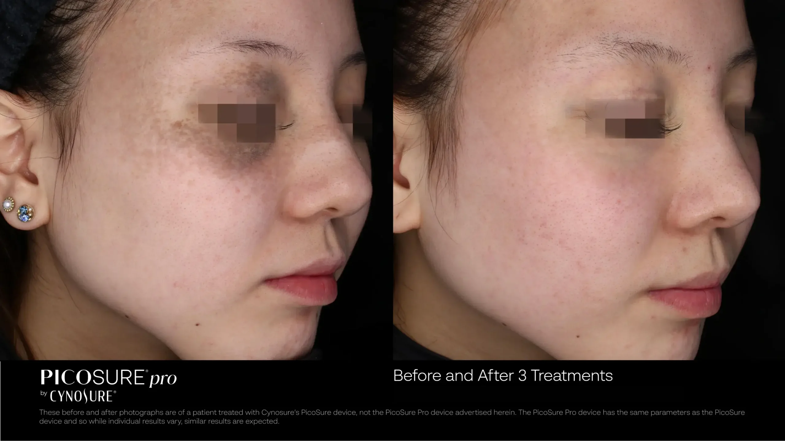 66ccf7d7521b772e301911cf_melasma-before-after-07