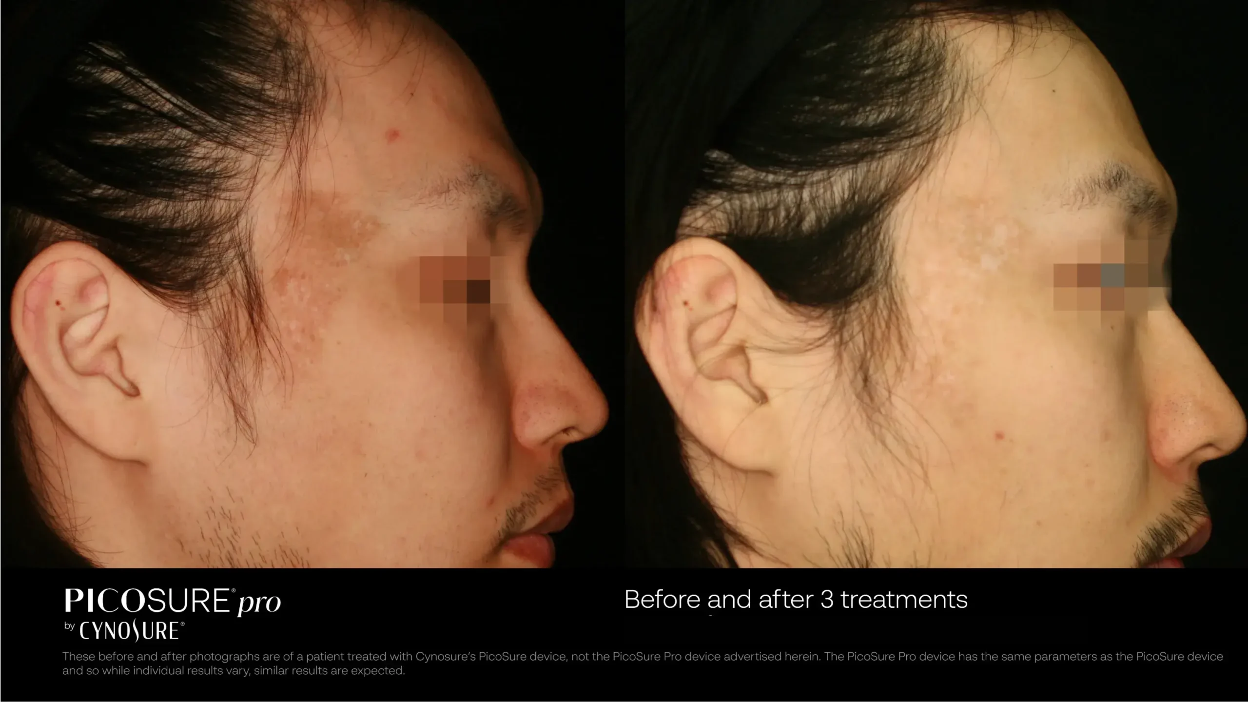 66ccf7d75d569ddee54e8618_melasma-before-after-01