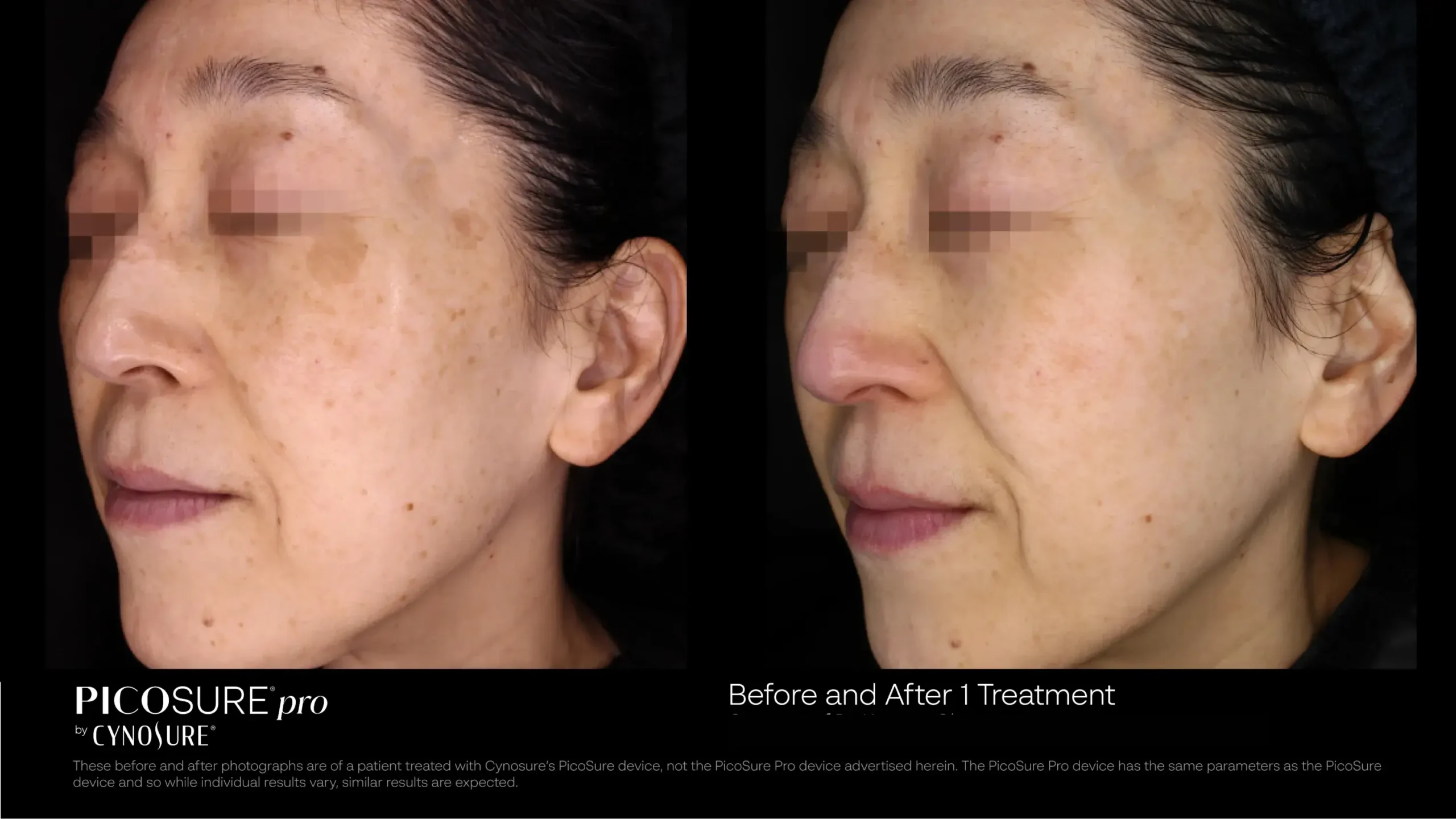 66ccf7d7907363afd9c3e352_melasma-before-after-13