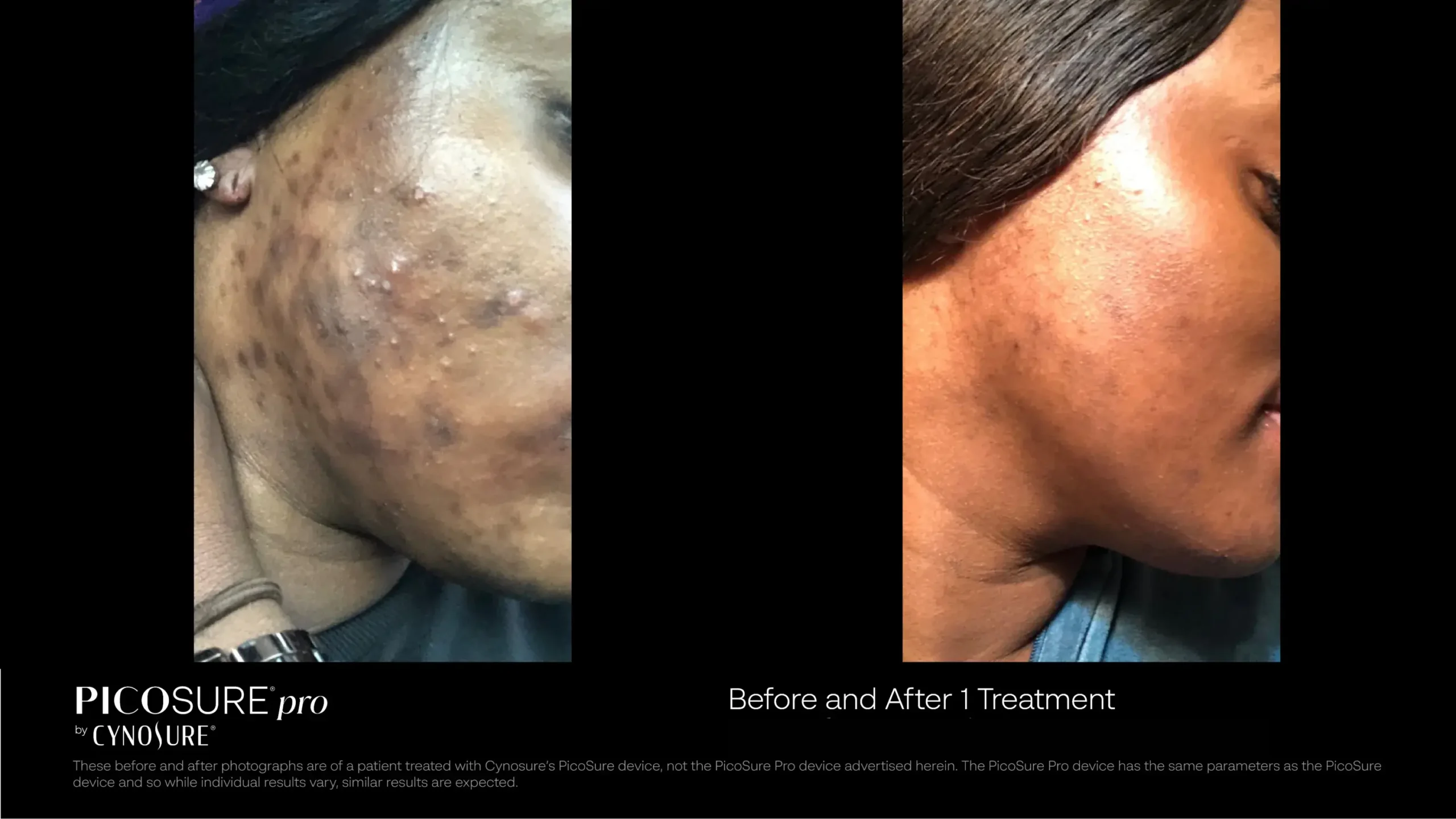 66ccf7d7b4714a4c7251104f_melasma-before-after-10
