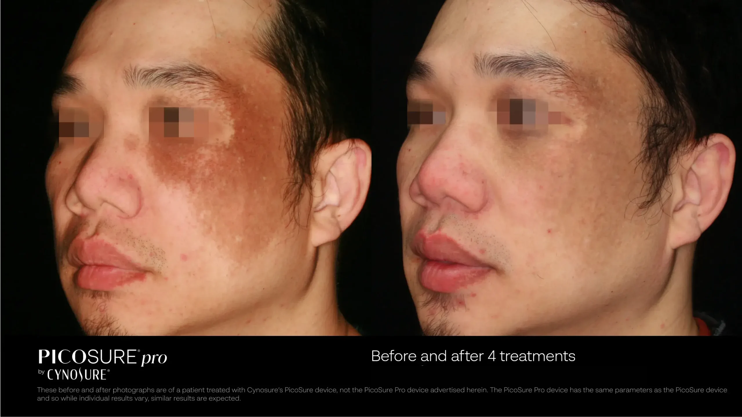 66ccf7d7da7565a2de33dc68_melasma-before-after-02