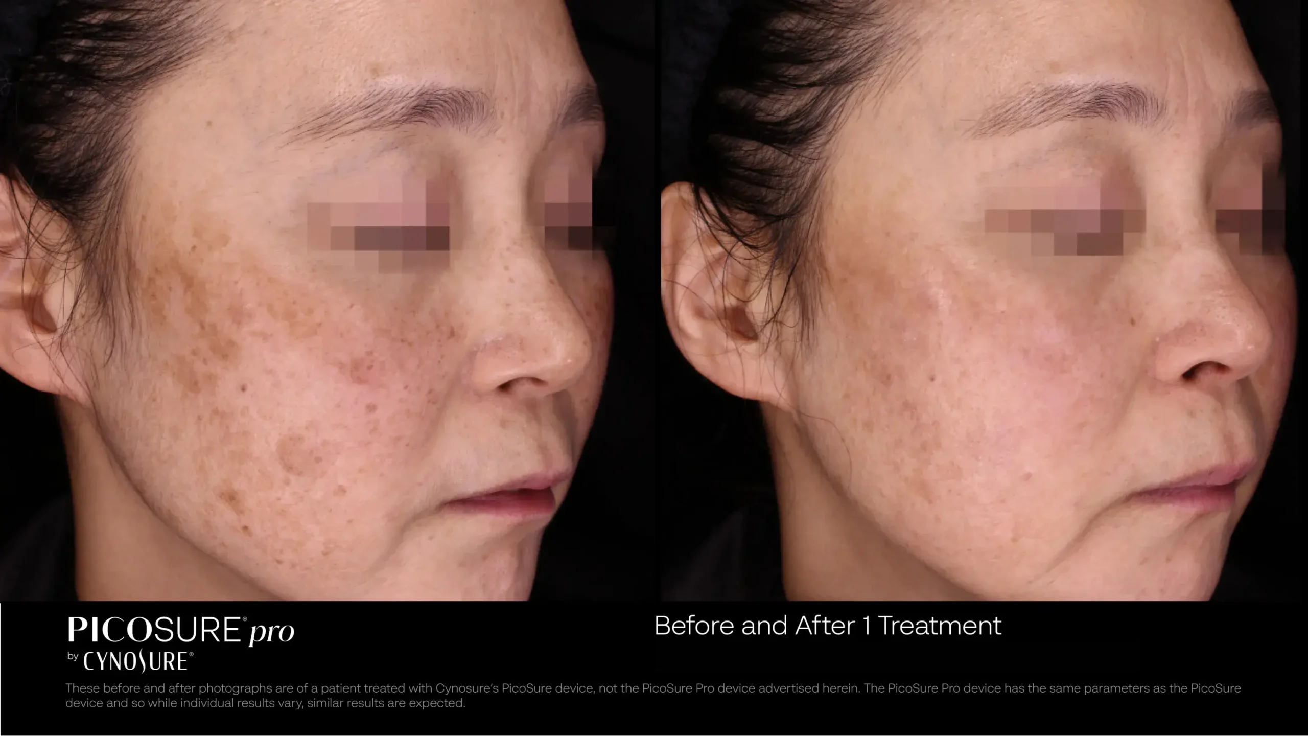 66ccf7d7dd7eab4ada05fe58_melasma-before-after-03