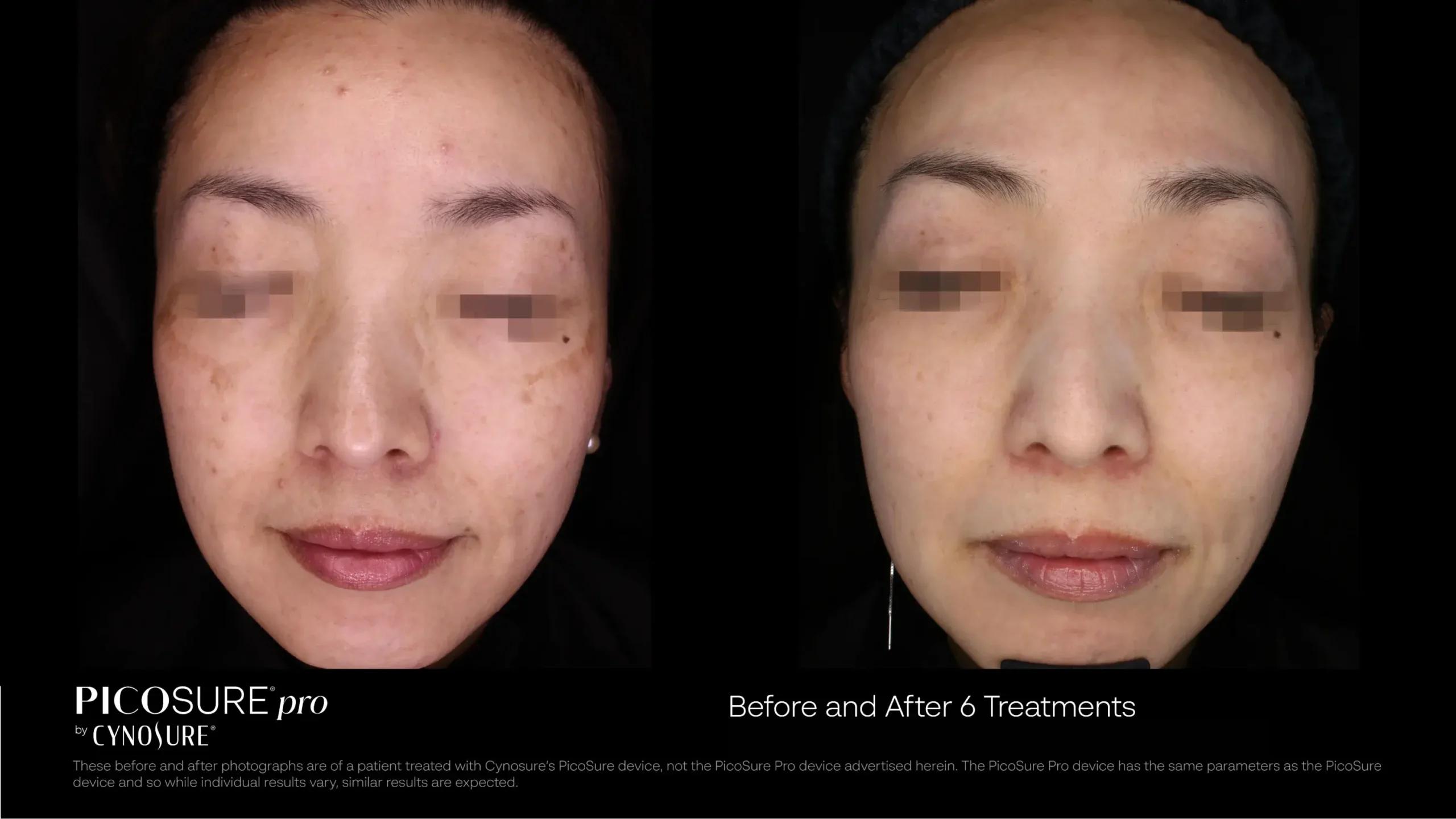 66ccf7d7dd7eab4ada05ff2c_melasma-before-after-12 (1)