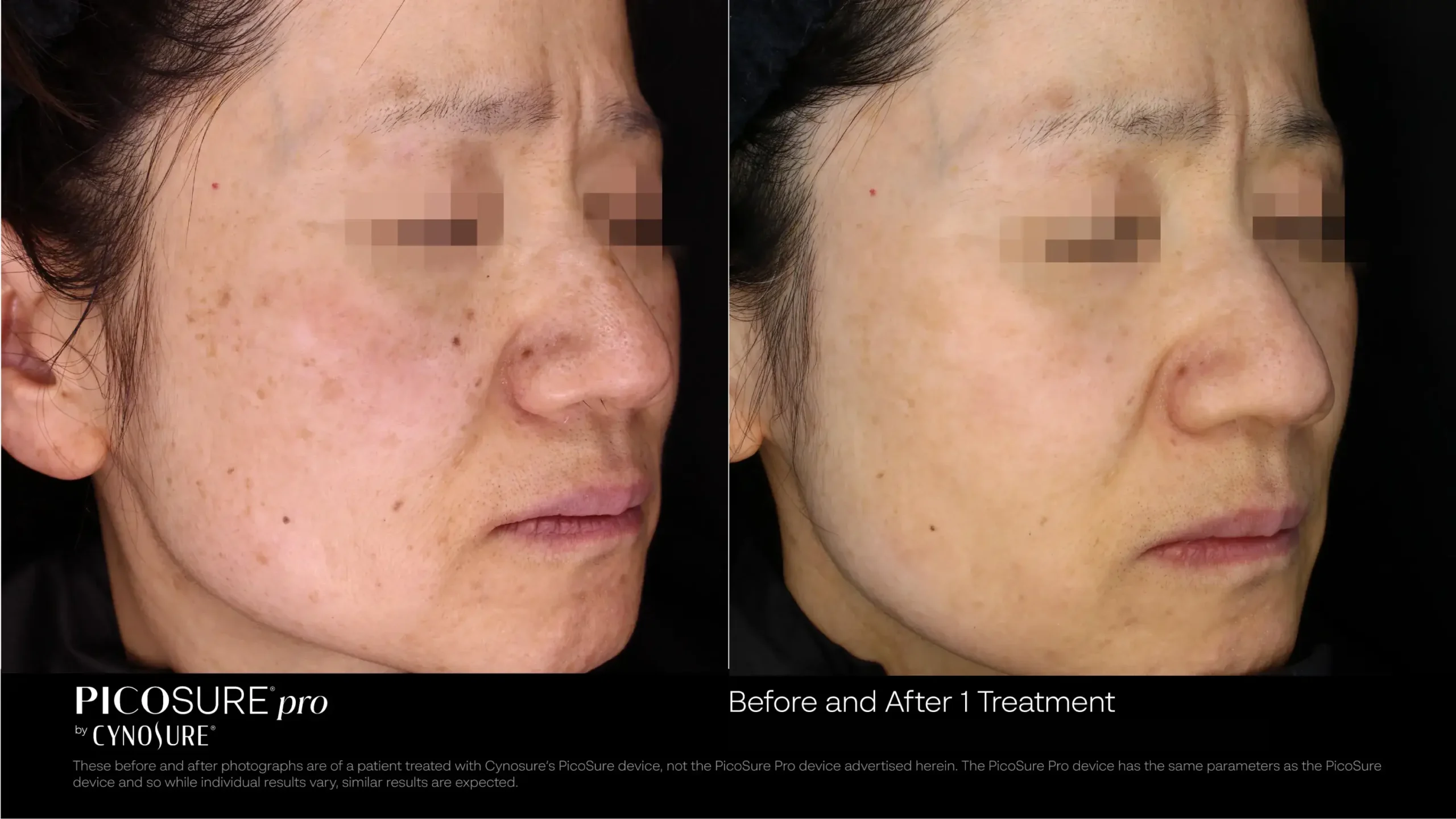66ccf7d7ebd368b7ef841668_melasma-before-after-11