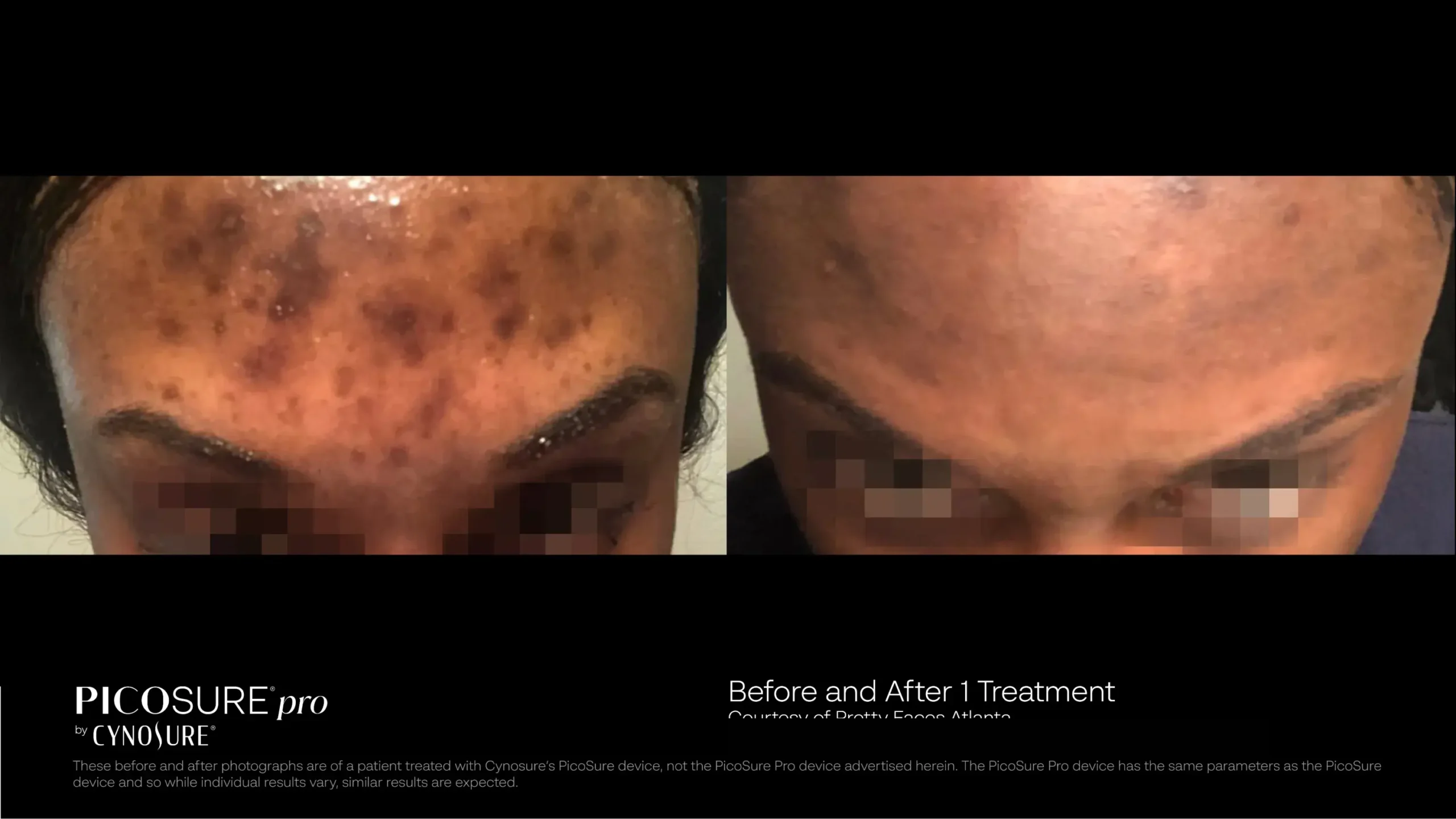 66ccf7d7f07e8206cb804c90_melasma-before-after-09 (1)